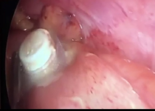 Nam bệnh nhân thủng ruột vì uống thuốc còn nguyên vỉ - 1 Nam bệnh nhân thủng ruột vì uống thuốc còn nguyên vỉ - 1