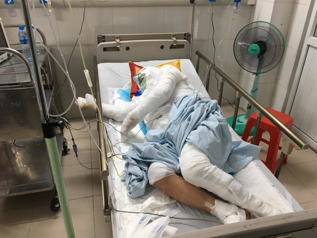 Truy tìm ôtô tông xe ba bánh bốc cháy rồi bỏ trốn khi chủ xe bỏng nặng - 2 Truy tìm ôtô tông xe ba bánh bốc cháy rồi bỏ trốn khi chủ xe bỏng nặng - 2