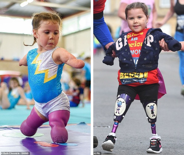 Cảm phục nghị lực của cô bé vận động viên 5 tuổi mất cả tứ chi vì viêm màng não - Ảnh minh hoạ 3
