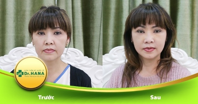 Bác sĩ Nguyễn Công Hân – Người xóa đi ám ảnh chảy xệ da tuổi trung niên - 3 Bác sĩ Nguyễn Công Hân – Người xóa đi ám ảnh chảy xệ da tuổi trung niên - 3