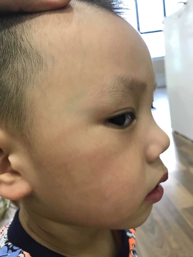 Hà Nội: Cô giáo “vuốt” má bé 3 tuổi hằn cả bàn tay và tụ máu môi - 1 Hà Nội: Cô giáo “vuốt” má bé 3 tuổi hằn cả bàn tay và tụ máu môi - 1