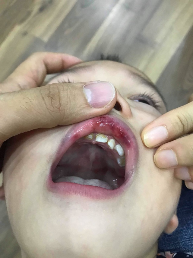Hà Nội: Cô giáo “vuốt” má bé 3 tuổi hằn cả bàn tay và tụ máu môi - 2 Hà Nội: Cô giáo “vuốt” má bé 3 tuổi hằn cả bàn tay và tụ máu môi - 2