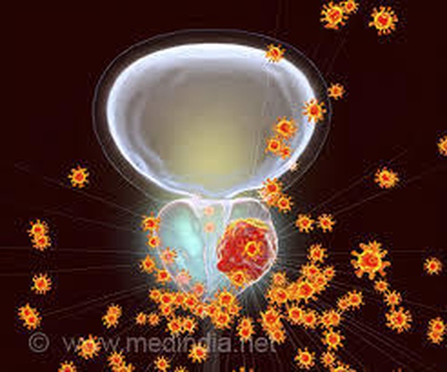 PUR: Test quý để lượng giá mức độ ung thư tiền liệt - 1 PUR: Test quý để lượng giá mức độ ung thư tiền liệt - 1