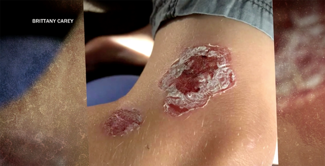 Người đàn ông bị nhiễm vi khuẩn ăn thịt mà không cần chạm vào nước - 1 Người đàn ông bị nhiễm vi khuẩn ăn thịt mà không cần chạm vào nước - 1