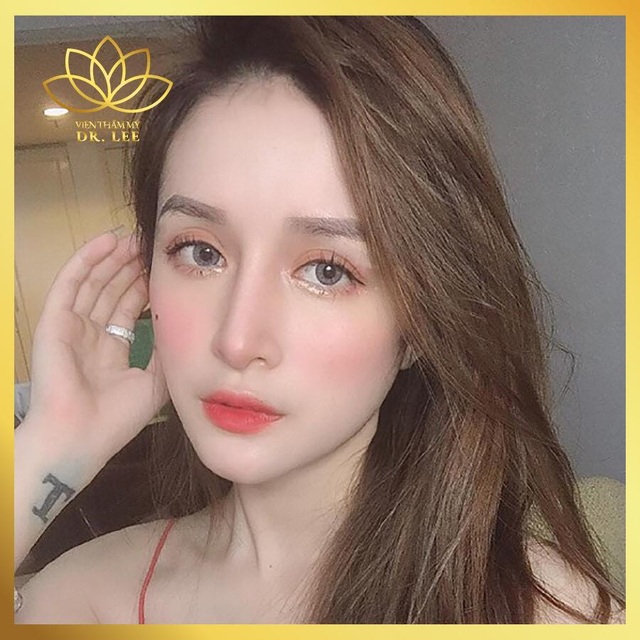 Giải mã “cơn sốt” nâng mũi Perfect line - 2 Giải mã “cơn sốt” nâng mũi Perfect line - 2