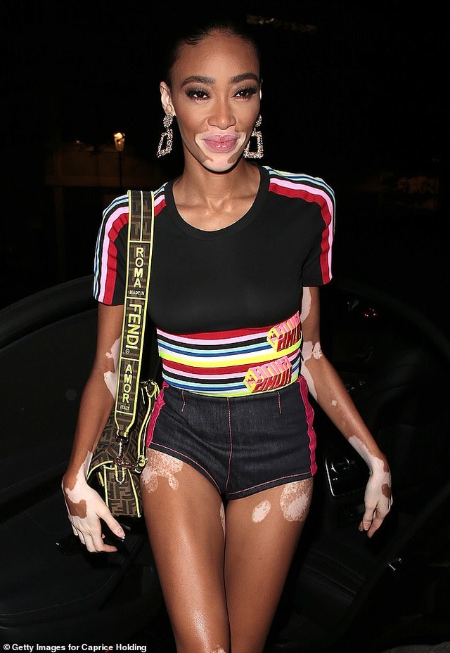 Winnie Harlow khoe dáng thon bốc lửa - 2 Winnie Harlow khoe dáng thon bốc lửa - 2