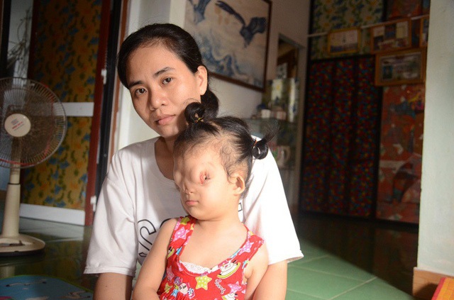 Hành trình tìm lại hy vọng cho cô bé có gương mặt dị dạng - 1 Hành trình tìm lại hy vọng cho cô bé có gương mặt dị dạng - 1