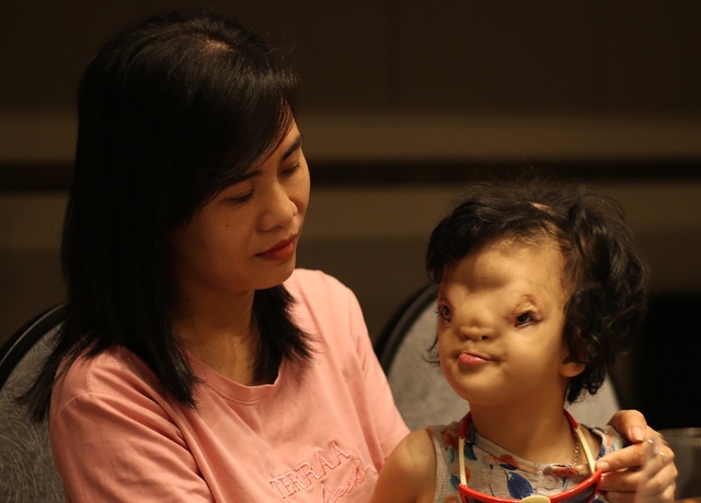 Hành trình tìm lại hy vọng cho cô bé có gương mặt dị dạng - 2 Hành trình tìm lại hy vọng cho cô bé có gương mặt dị dạng - 2