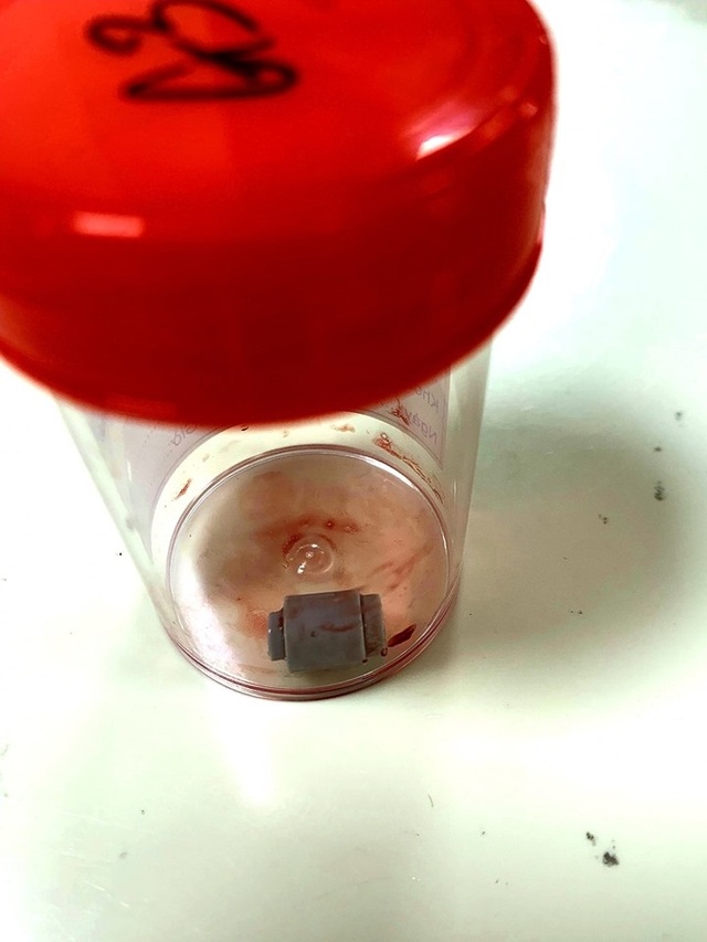 Cuộc chuyển viện lúc nửa đêm cứu cậu bé bị nghẽn đường thở - 2 Cuộc chuyển viện lúc nửa đêm cứu cậu bé bị nghẽn đường thở - 2