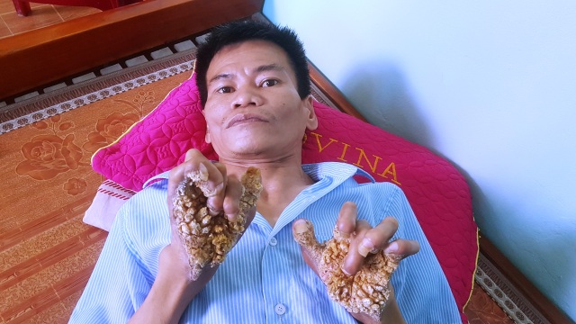Gặp người đầu tiên mắc căn bệnh kỳ lạ “người cây” ở Việt Nam - 8 Gặp người đầu tiên mắc căn bệnh kỳ lạ “người cây” ở Việt Nam - 8