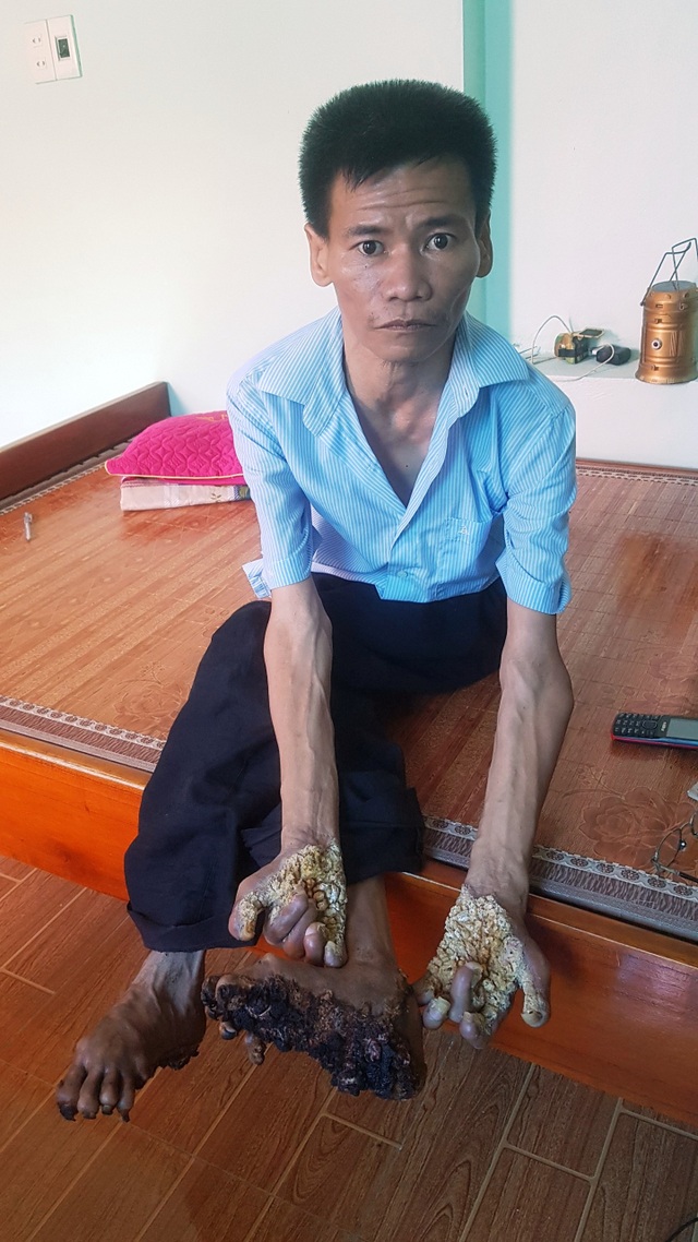 Gặp người đầu tiên mắc căn bệnh kỳ lạ “người cây” ở Việt Nam - 2 Gặp người đầu tiên mắc căn bệnh kỳ lạ “người cây” ở Việt Nam - 2