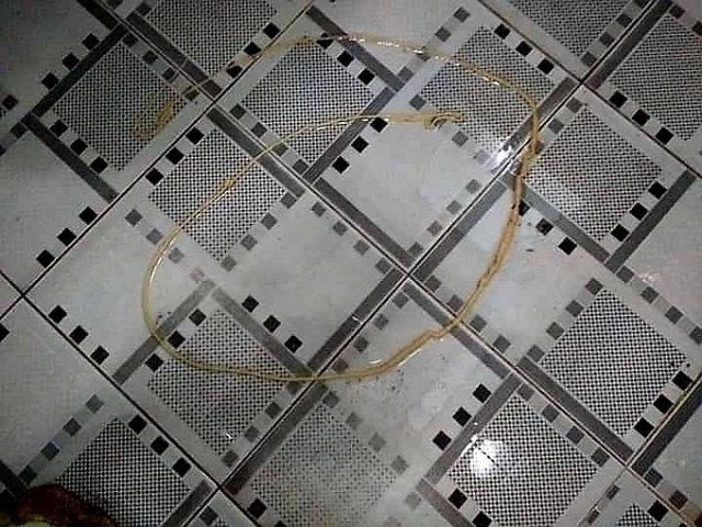 Kinh hãi sán xơ mít dài hơn 2m trong bụng bệnh nhân - 1 Kinh hãi sán xơ mít dài hơn 2m trong bụng bệnh nhân - 1
