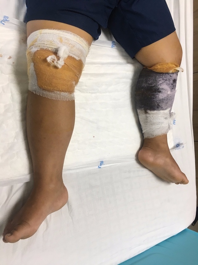 Bé trai 7 tuổi phải khâu 70 mũi sau khi bị chó ngoạm lòi cơ chân - 2 Bé trai 7 tuổi phải khâu 70 mũi sau khi bị chó ngoạm lòi cơ chân - 2