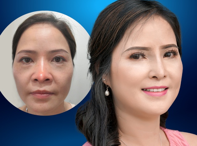 Cứu chữa thành công chiếc mũi biến dạng cho nữ Việt kiều - 1 Cứu chữa thành công chiếc mũi biến dạng cho nữ Việt kiều - 1