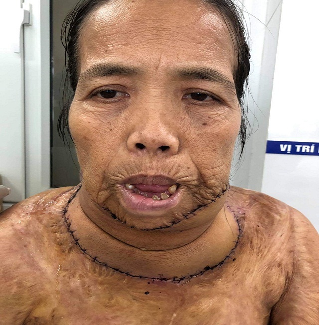 Người đàn bà mang hàm răng “kỳ dị” đã có “khuôn mặt mới” sau ca phẫu thuật - 5 Người đàn bà mang hàm răng “kỳ dị” đã có “khuôn mặt mới” sau ca phẫu thuật - 5