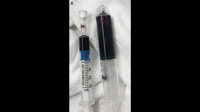 Hiếm gặp: Bệnh nhân máu chuyển màu xanh sau khi sử dụng thuốc gây tê thông thường - Ảnh minh hoạ 2