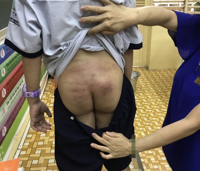 TPHCM: Nghi vấn bé trai bị bạo hành kéo dài khi ở cùng bố, mẹ kế - 1 TPHCM: Nghi vấn bé trai bị bạo hành kéo dài khi ở cùng bố, mẹ kế - 1