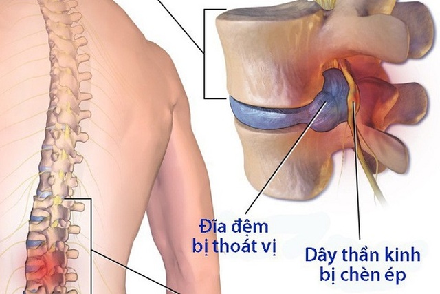 Giải pháp khắc phục cơn đau đến không ngủ, không đi được của tay vợt cầu lông U70 bị thoát vị đĩa đệm L1, 2, 3, 5 - 1 Giải pháp khắc phục cơn đau đến không ngủ, không đi được của tay vợt cầu lông U70 bị thoát vị đĩa đệm L1, 2, 3, 5 - 1