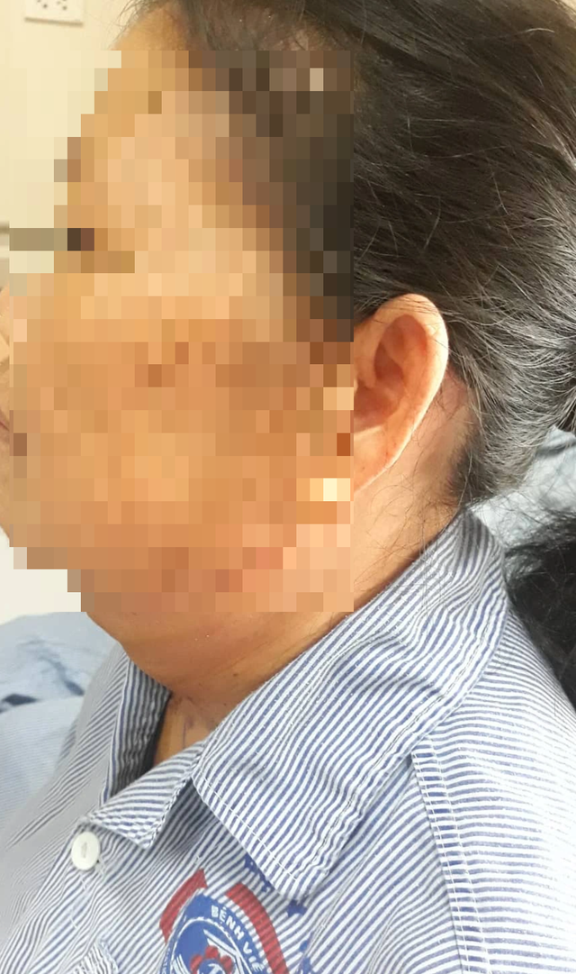 Người phụ nữ được giải thoát sau 20 năm dùng khăn, tay đỡ khối u treo lủng lẳng trước cổ - 2 Người phụ nữ được giải thoát sau 20 năm dùng khăn, tay đỡ khối u treo lủng lẳng trước cổ - 2