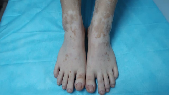 Ngâm chân lá trầu không có tác dụng làm giảm sưng chân không?
