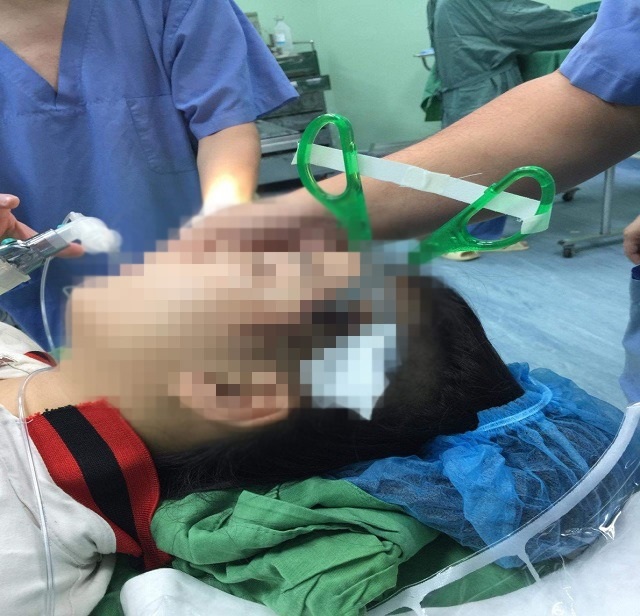 Bé gái 10 tuổi nguy kịch vì bị kéo nhọn găm vào đầu - 1 Bé gái 10 tuổi nguy kịch vì bị kéo nhọn găm vào đầu - 1