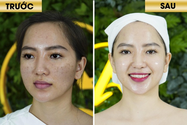 Lộ diện siêu phẩm từ Hàn Quốc được chuyển giao đầu tiên tại Thẩm Mỹ Quốc Tế Linh Anh - 3 Lộ diện siêu phẩm từ Hàn Quốc được chuyển giao đầu tiên tại Thẩm Mỹ Quốc Tế Linh Anh - 3