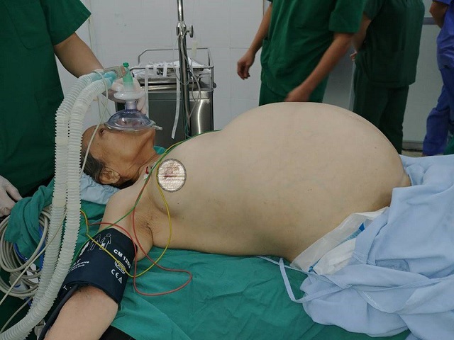 Cụ bà 70 tuổi mang khối u buồng trứng nặng 20kg - 2 Bệnh nhân rơi vào tình trạng khó thở, ăn uống kém phải chỉ định phẫu thuật