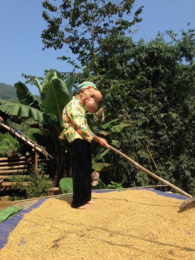 Mẹ chết ngất nhìn con chào đời mang u khủng dị thường trên mặt! - 10 Mẹ chết ngất nhìn con chào đời mang u khủng dị thường trên mặt! - 10