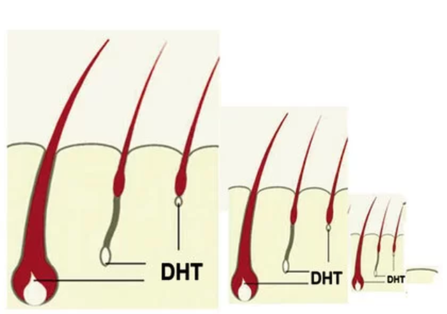 Chữa hói đầu sớm, rụng tóc nhiều: Biết trước điều này thật đáng giá biết bao nhiêu! - 3 Chữa hói đầu sớm, rụng tóc nhiều: Biết trước điều này thật đáng giá biết bao nhiêu! - 3