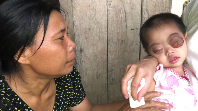 Bé gái có cặp mắt như quả bóng muốn nổ tung cầu cứu...! - 6 Bé gái có cặp mắt như quả bóng muốn nổ tung cầu cứu...! - 6