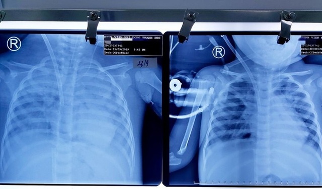 Bé 3 tuổi tê liệt chức năng phổi vì suy hô hấp được cứu sống kỳ diệu - 3 Bé 3 tuổi tê liệt chức năng phổi vì suy hô hấp được cứu sống kỳ diệu - 3