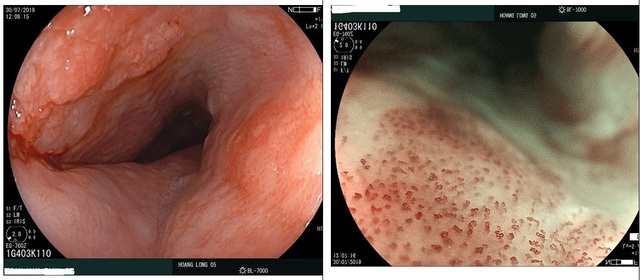 Phát hiện tổn thương ung thư sớm đường tiêu hoá nhờ hệ thống nội soi phóng đại 300 lần - 2 Phát hiện tổn thương ung thư sớm đường tiêu hoá nhờ hệ thống nội soi phóng đại 300 lần - 2