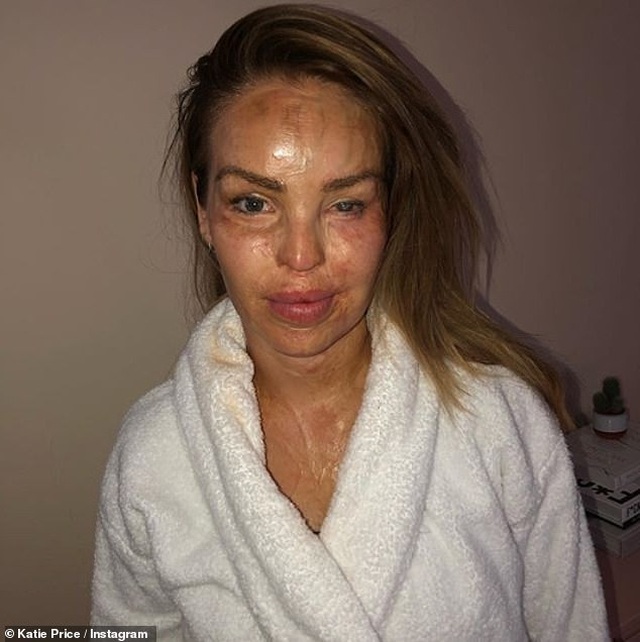 MC truyền hình Katie Piper hé lộ ảnh bị tạt axít - 4 MC truyền hình Katie Piper hé lộ ảnh bị tạt axít - 4