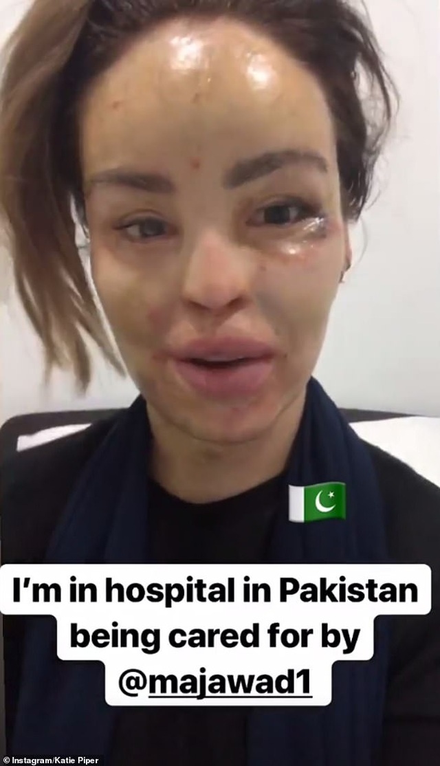 MC truyền hình Katie Piper hé lộ ảnh bị tạt axít - 6 MC truyền hình Katie Piper hé lộ ảnh bị tạt axít - 6