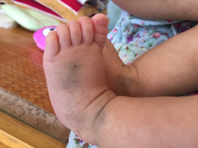 Ánh mắt cầu cứu của bé gái 5 tháng tuổi bị ung thư máu - 4 Ánh mắt cầu cứu của bé gái 5 tháng tuổi bị ung thư máu - 4