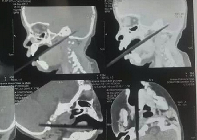 Bị đũa xuyên qua não, bé 17 tháng tuổi thoát chết thần kỳ