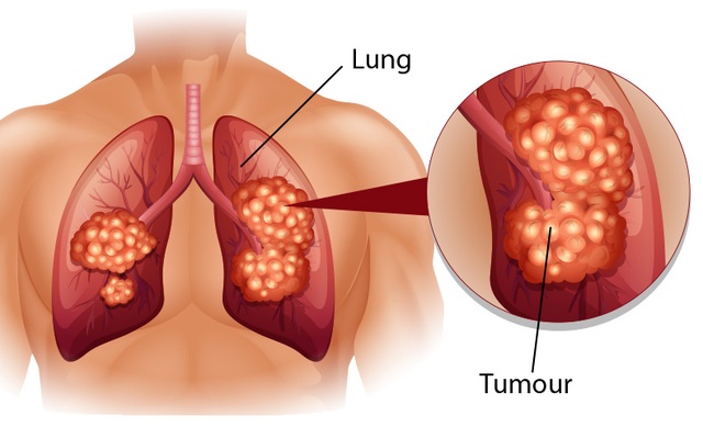 Mắc ung thư phổi có mổ được không? - 1 Mắc ung thư phổi có mổ được không? - 1