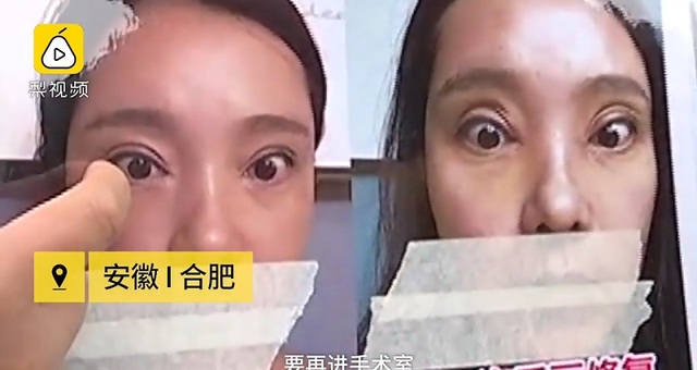 Thê thảm cô gái không thể nhắm mắt sau khi phẫu thuật cắt mí - 1 Thê thảm cô gái không thể nhắm mắt sau khi phẫu thuật cắt mí - 1
