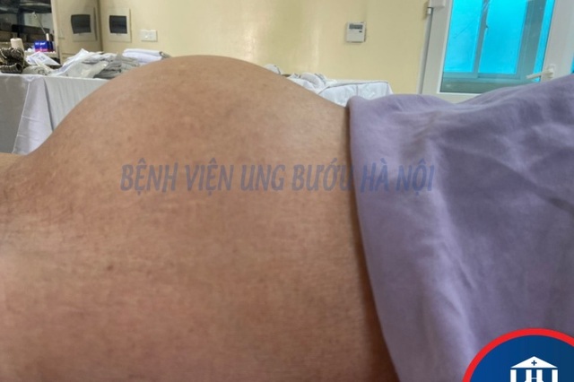 Cụ bà 81 tuổi bụng to như có bầu 6 tháng - 1 Cụ bà 81 tuổi bụng to như có bầu 6 tháng - 1