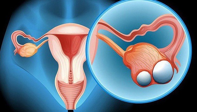Cô gái 23 tuổi chưa kết hôn đã bị ung thư dạ dày di căn buồng trứng, cảnh báo những thói quen xấu nhiều người mắc - 1 Cô gái 23 tuổi chưa kết hôn đã bị ung thư dạ dày di căn buồng trứng, cảnh báo những thói quen xấu nhiều người mắc