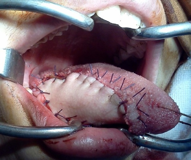 Lưỡi bị ung thư sau khi cắt được bác sĩ tái tạo như thế nào? | Báo ...