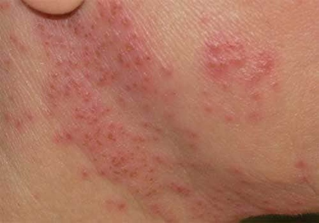 Cảnh báo: Kem trộn núp bóng mỹ phẩm thiên nhiên và những hiểm họa khôn lường - 8 Cảnh báo: Kem trộn núp bóng mỹ phẩm thiên nhiên và những hiểm họa khôn lường