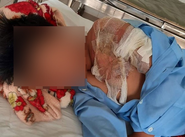 Bé trai 11 tuổi nghi bị cha ruột tạt nước sôi gây bỏng nặng - 1