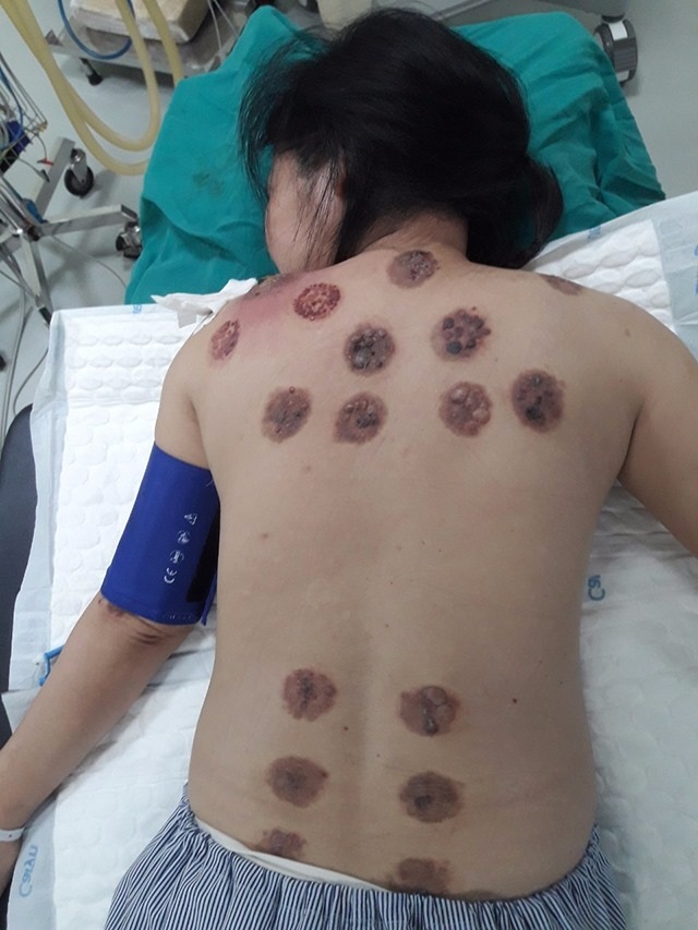 Sốc với hàng loạt lỗ hoại tử trên lưng người phụ nữ sau khi đi giác hơi - 1