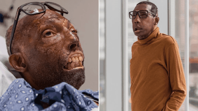 Ca ghép mặt hoàn toàn đầu tiên được thực hiện trên người da màu