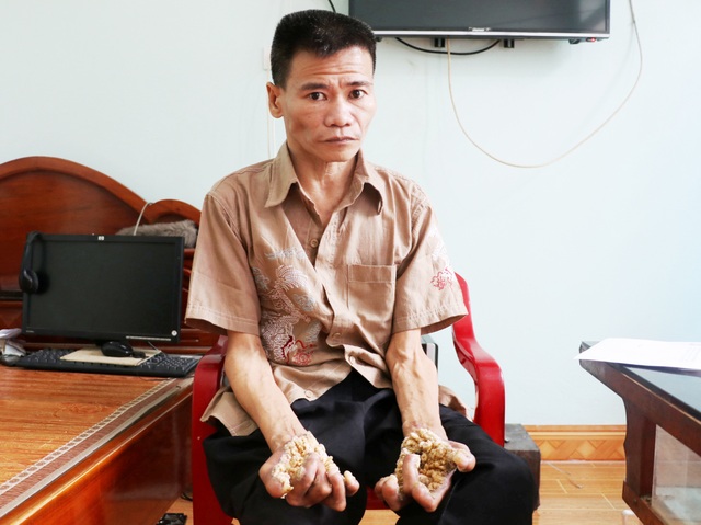 Thăm người đàn ông mang bệnh “người cây” ở Ninh Bình - 1 Thăm người đàn ông mang bệnh “người cây” ở Ninh Bình - 1