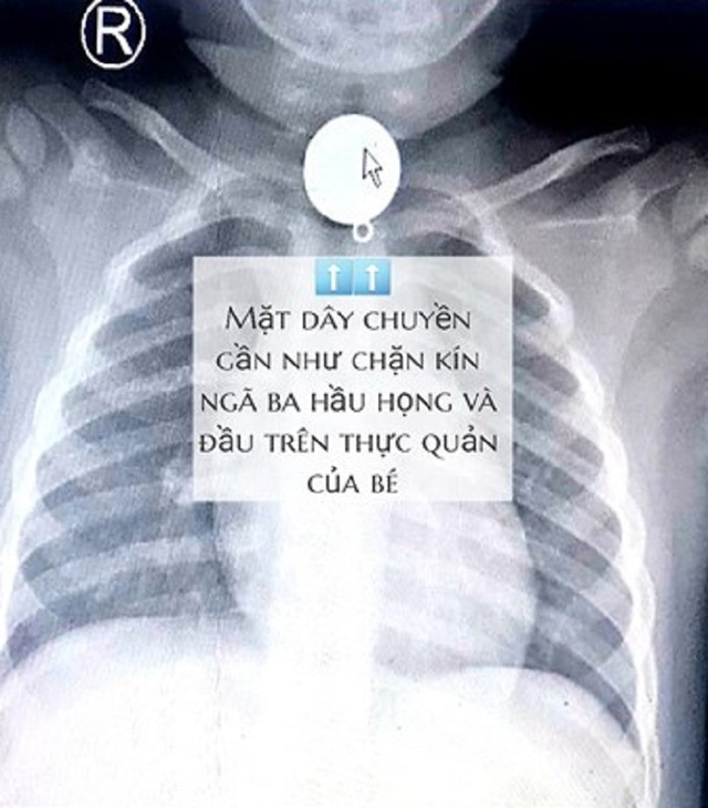 Mặt dây chuyền mắc ngang cổ họng, bé trai suýt tử vong - 1 Mặt dây chuyền mắc ngang cổ họng, bé trai suýt tử vong - 1