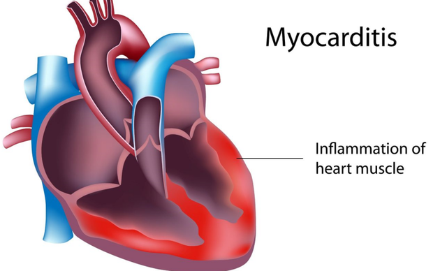 Bệnh viêm cơ tim có thể gây suy tim không?
