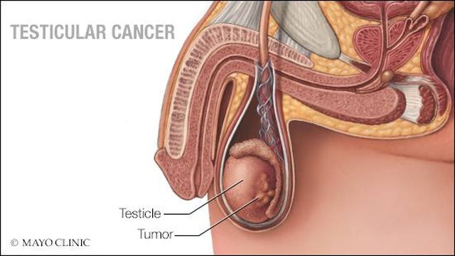 Chuyên gia hướng dẫn cách tự khám phát hiện sớm ung thư tinh hoàn - 1 Chuyên gia hướng dẫn cách tự khám phát hiện sớm ung thư tinh hoàn - 1