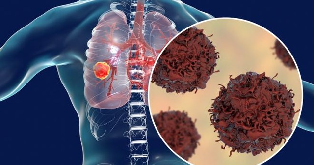Các tác nhân gây ung thư phổi, căn bệnh “sát thủ” hàng đầu ở nam giới - 1